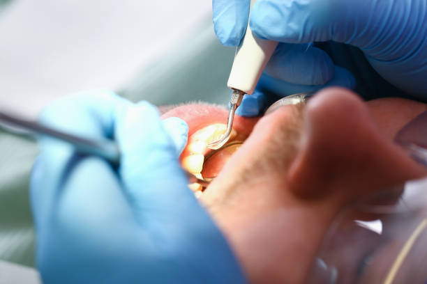 Best Dental Abscess Treatment in Stevenson, AL